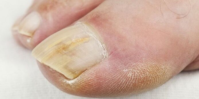 symptoms of toenail fungus