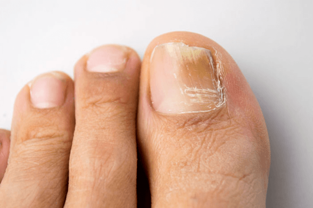symptoms of fungus on the big toe photo 4