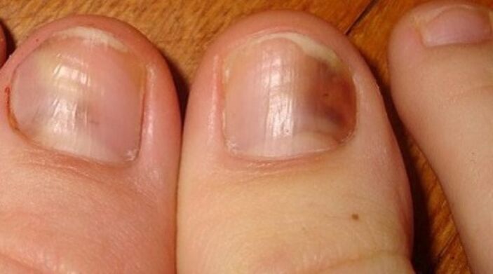 fungal nail infection