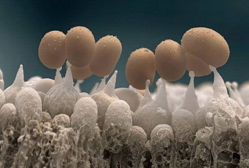 toenail fungus under a microscope