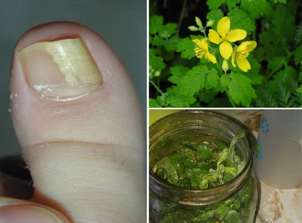 celandine for the treatment of toenail fungus
