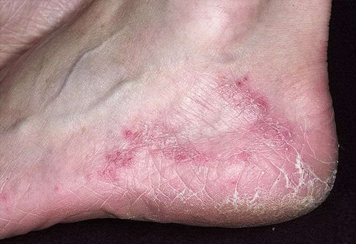 Cracks and redness of the skin of the heels are signs of a fungal infection