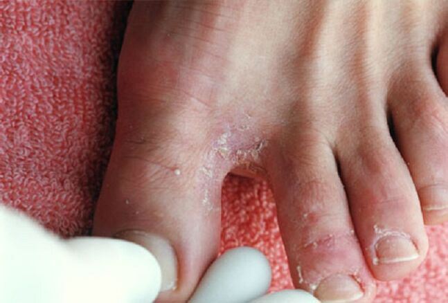 Manifestations of intertriginous fungus between the toes