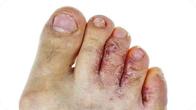 How does foot fungus appear 