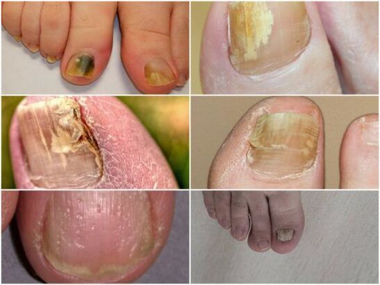 symptoms of fungal nail infection