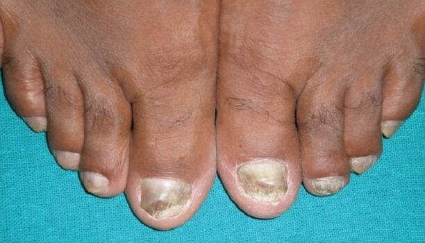 Fungus on the nails