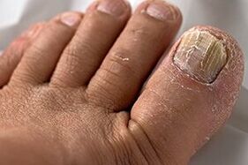 Photo of nail fungus