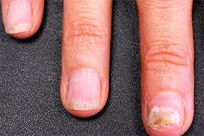 The fungus is on the hands