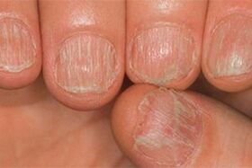 The lesion of the fungus