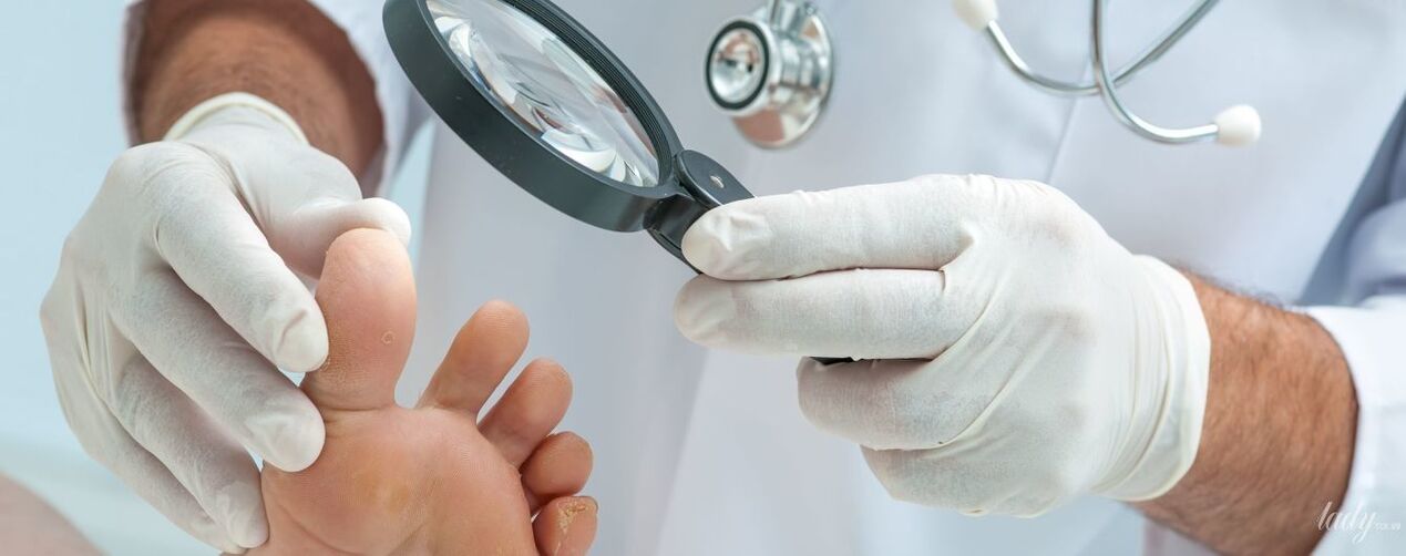 The doctor examines the fungus on the toe