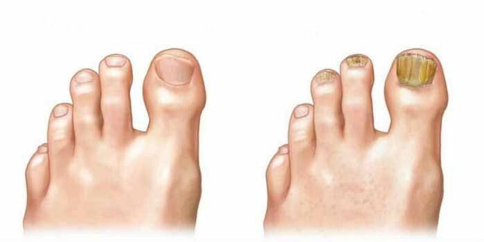 What does the fungus look like on the nails