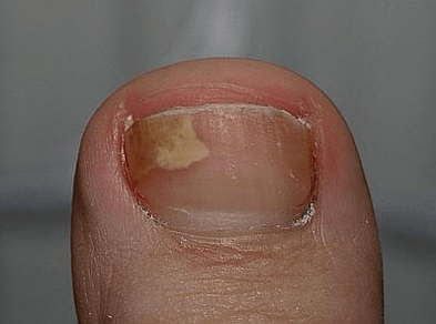 fungus in the left side of the nail
