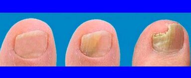 Stages of the development of the fungus on the toes