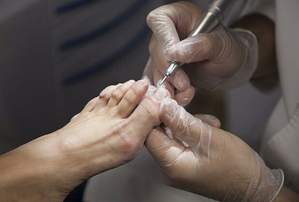 Diagnosis of the fungus of the legs