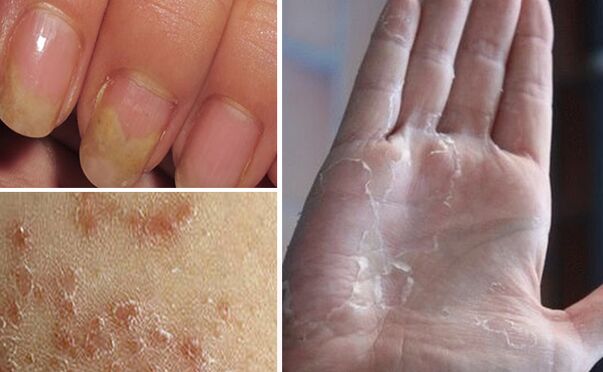 can mycosis switch to other parts of the body