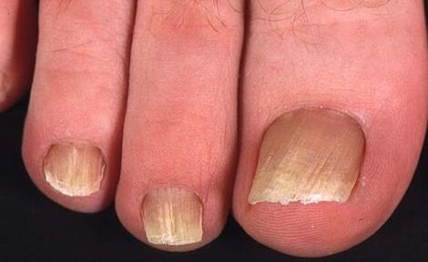 type of toenail fungus