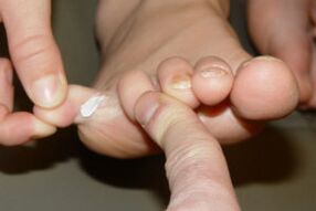 fungus on toes