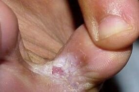 symptoms of fungus between toes