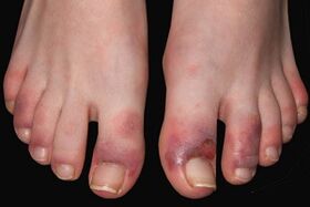 symptoms of fungus on toes