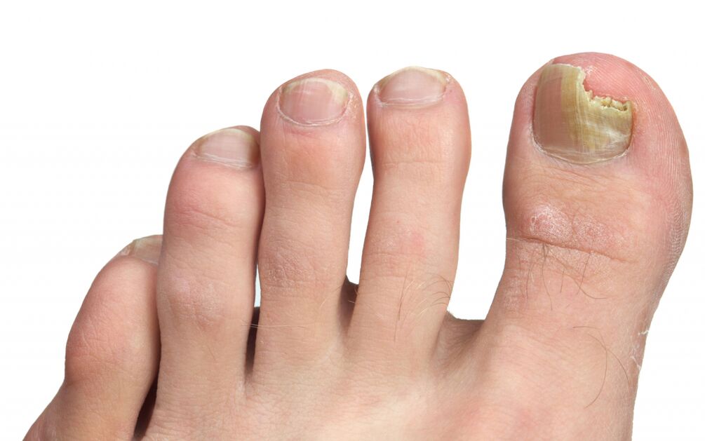toenail fungus stages