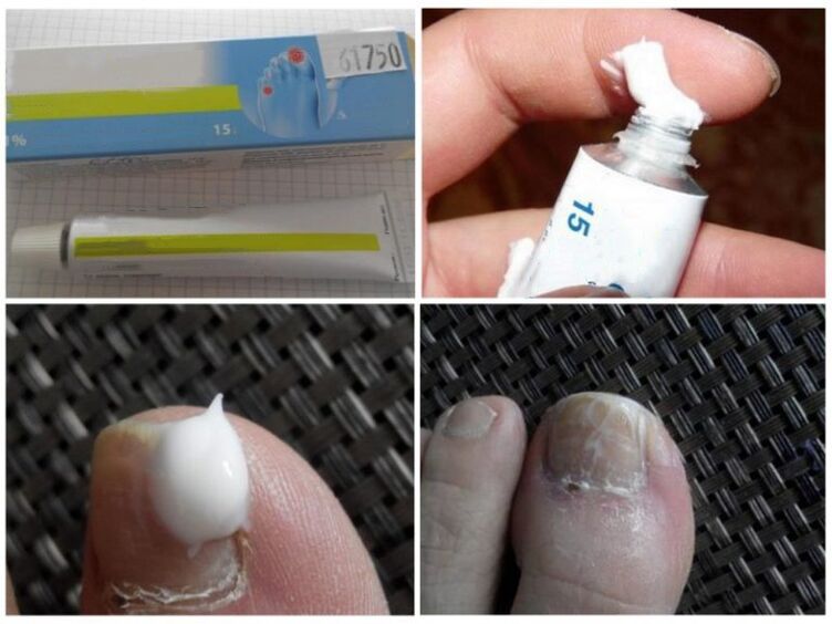 ointments against toenail fungus
