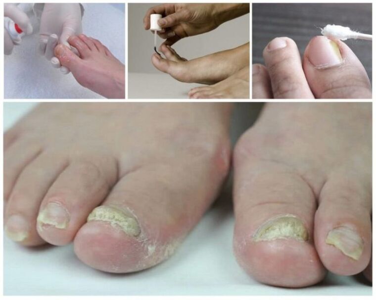 remedies for toenail fungus