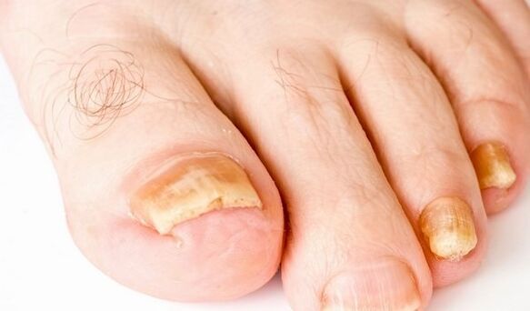 photo of symptoms of toenail fungus